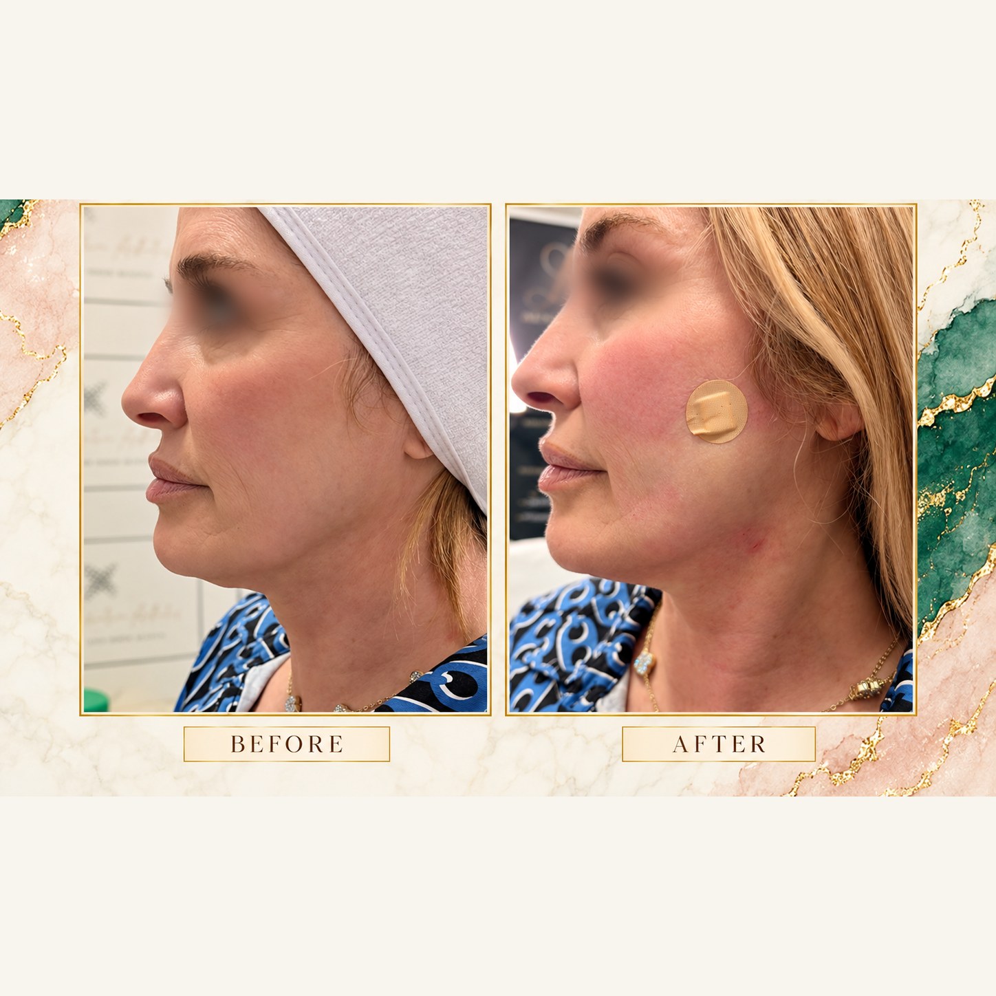 Jawline lift before and after