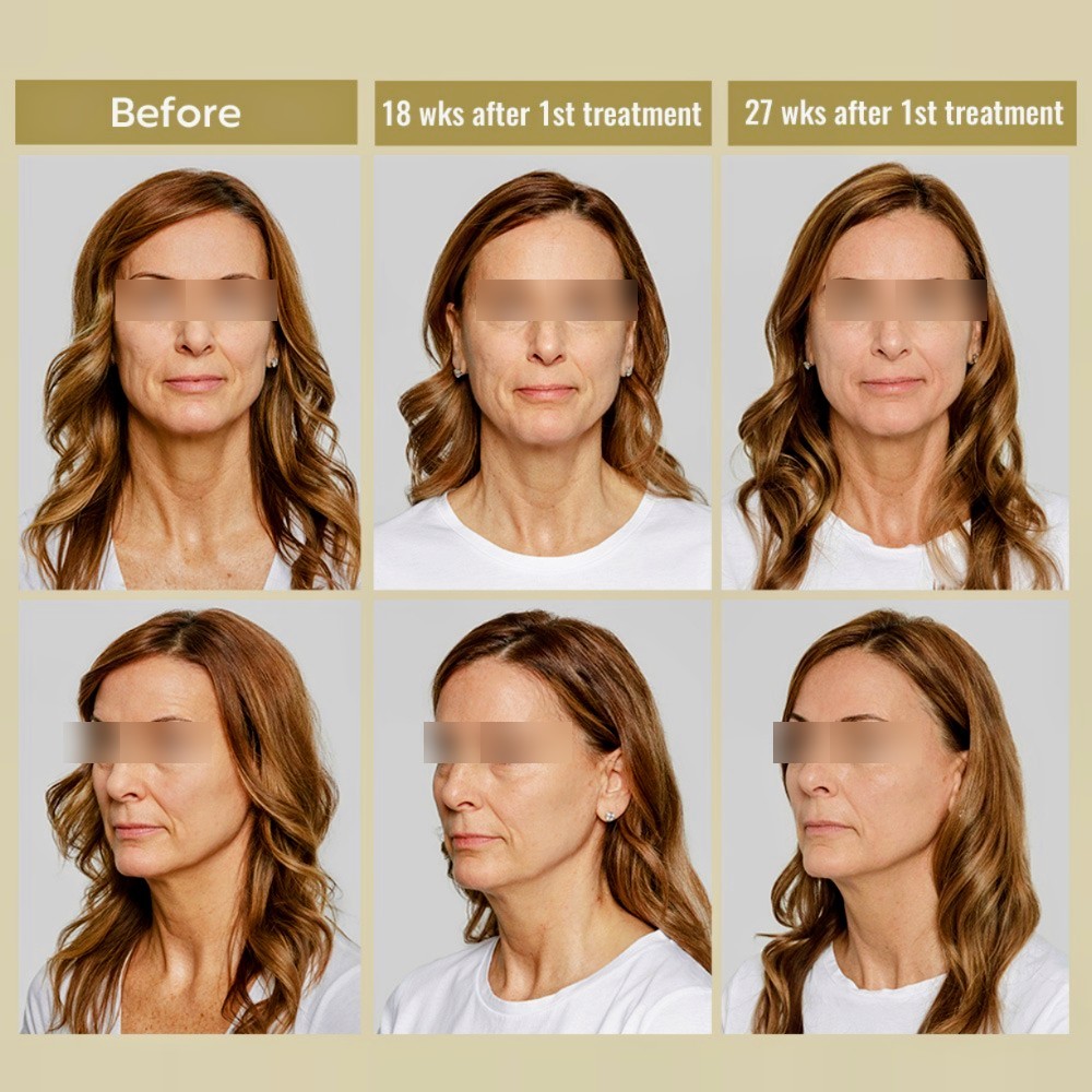 Sculptra®