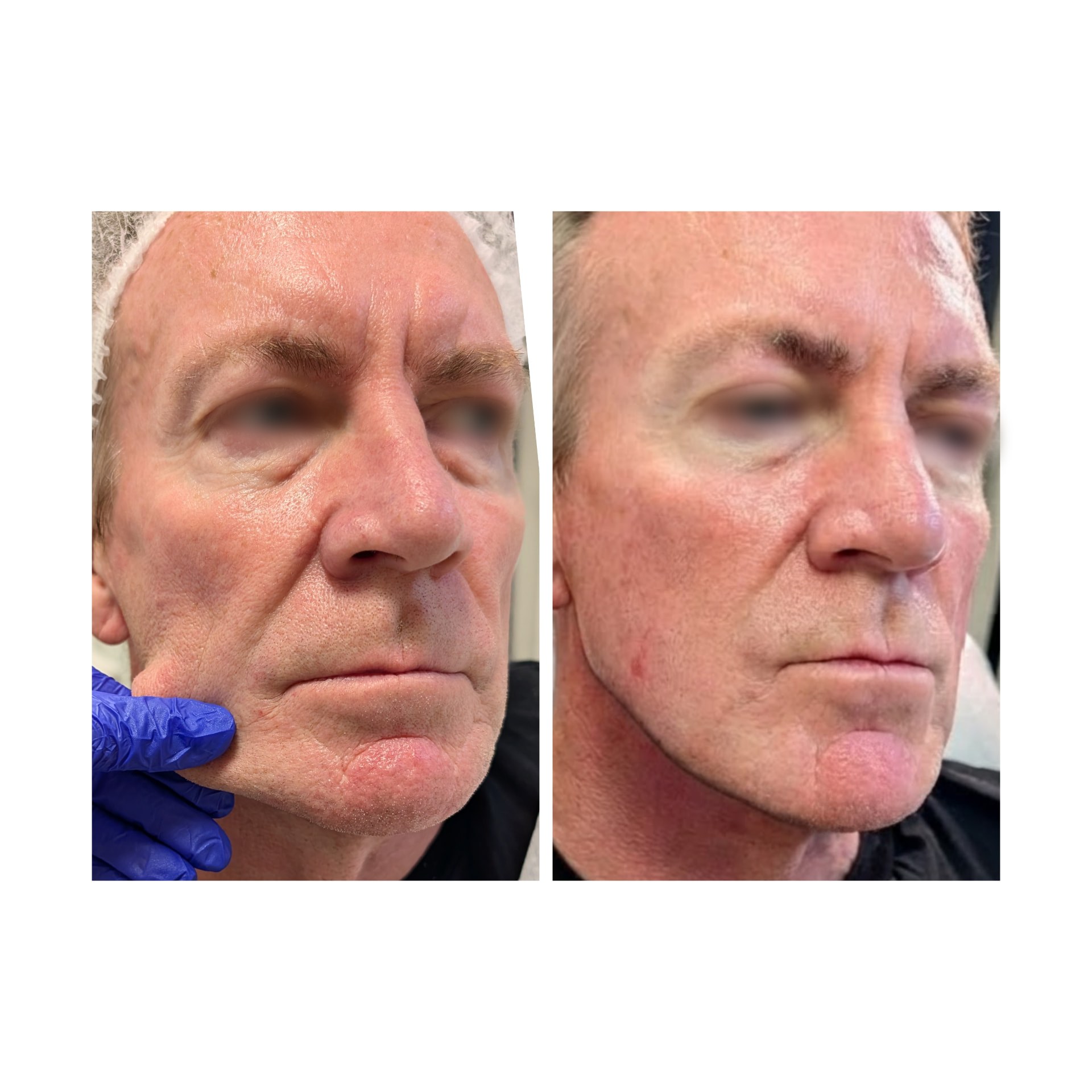 Facial lift & contour before and after